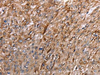 The image on the left is immunohistochemistry of paraffin-embedded Human esophagus cancer tissue using GRPR Antibody(GRPR Antibody) at dilution 1/40, on the right is treated with synthetic peptide. (Original magnification: ×200)Rabbit anti-Human GRPR Polyclonal Antibody