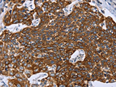 The image on the left is immunohistochemistry of paraffin-embedded Human cervical cancer tissue using the antibody Antibody) at dilution 1/40, on the right is treated with synthetic peptide. (Original magnification: ×200)Rabbit anti-Human GRPR Polyclonal Antibody