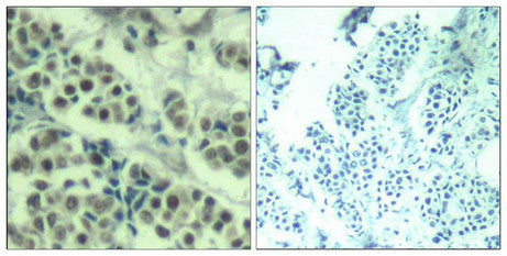Immunohistochemical analysis of paraffin-embedded human breast carcinoma tissue using MDM2(Ab-166) Antibody(left) or the same antibody preincubated with blocking peptide(right).