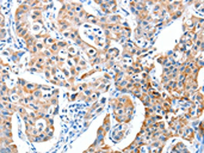 The image on the left is immunohistochemistry of paraffin-embedded Human lung cancer tissue using AEBP2 Antibody(AEBP2 Antibody) at dilution 1/25, on the right is treated with fusion protein. (Original magnification: ×200)Rabbit anti-Human AEBP2 Polyclonal Antibody