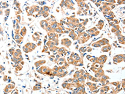 The image on the left is immunohistochemistry of paraffin-embedded Human breast cancer tissue using the antibody Antibody) at dilution 1/25, on the right is treated with fusion protein. (Original magnification: ×200)