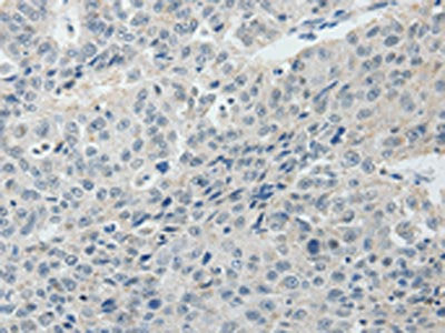 The image on the left is immunohistochemistry of paraffin-embedded Human lung cancer tissue using RUNX3 Antibody(RUNX3 Antibody) at dilution 1/25, on the right is treated with synthetic peptide. (Original magnification: ×200)Rabbit anti-Human RUNX3 Polyclonal Antibody