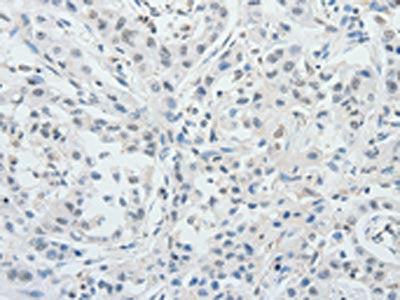 The image on the left is immunohistochemistry of paraffin-embedded Human ovarian cancer tissue using the antibody Antibody) at dilution 1/25, on the right is treated with synthetic peptide. (Original magnification: ×200)Rabbit anti-Human RUNX3 Polyclonal Antibody