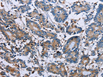 The image on the left is immunohistochemistry of paraffin-embedded Human colon cancer tissue using PLG Antibody(PLG Antibody) at dilution 1/40, on the right is treated with synthetic peptide. (Original magnification: ×200)