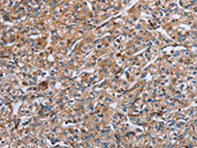 The image on the left is immunohistochemistry of paraffin-embedded Human prostate cancer tissue using the antibody Antibody) at dilution 1/40, on the right is treated with synthetic peptide. (Original magnification: ×200)
