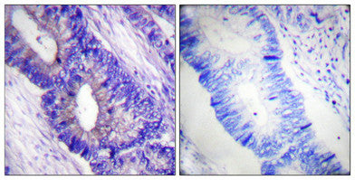 Immunohistochemical analysis of paraffin-embedded human colon carcinoma tissue using PKA α/β CAT (Phospho-Thr197) antibody (left)or the same antibody preincubated with blocking peptide (right).Rabbit anti-Human PRKACA Polyclonal Antibody