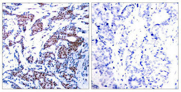 Immunohistochemical analysis of paraffin-embedded human breast carcinoma tissue using c-Jun(Phospho-Ser73) Antibody(left) or the same antibody preincubated with blocking peptide(right).