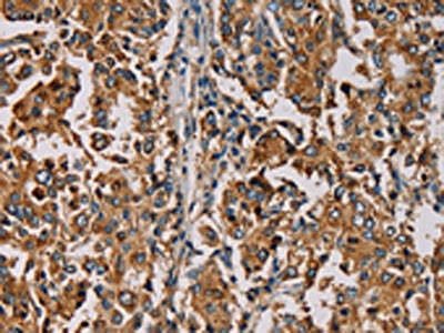 The image on the left is immunohistochemistry of paraffin-embedded Human liver cancer tissue using MRPL11 Antibody(MRPL11 Antibody) at dilution 1/20, on the right is treated with fusion protein. (Original magnification: ×200)Rabbit anti-Human MRPL11 Polyclonal Antibody