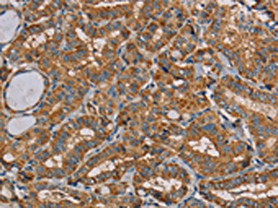 The image on the left is immunohistochemistry of paraffin-embedded Human thyroid cancer tissue using the antibody Antibody) at dilution 1/20, on the right is treated with fusion protein. (Original magnification: ×200)Rabbit anti-Human MRPL11 Polyclonal Antibody