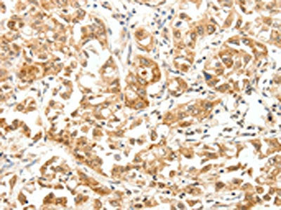 The image on the left is immunohistochemistry of paraffin-embedded Human lung cancer tissue using PAK7 Antibody(PAK7 Antibody) at dilution 1/10, on the right is treated with fusion protein. (Original magnification: ×200)Rabbit anti-Human PAK7 Polyclonal Antibody