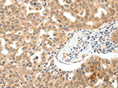 The image on the left is immunohistochemistry of paraffin-embedded Human ovarian cancer tissue using the antibody Antibody) at dilution 1/10, on the right is treated with fusion protein. (Original magnification: ×200)Rabbit anti-Human PAK7 Polyclonal Antibody