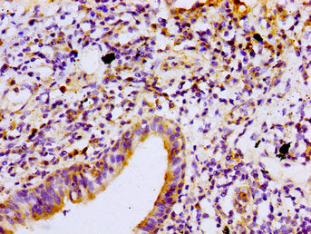 Immunohistochemistry of paraffin-embedded human lung cancer using PRKCB Antibody at dilution of 1:100Rabbit anti-Human PRKCB Polyclonal Antibody