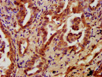 IHC image of PRKCH Antibody diluted at 1:700 and staining in paraffin-embedded human lung cancer performed on a Leica BondTM system. After dewaxing and hydration, antigen retrieval was mediated by high pressure in a citrate buffer (pH 6.0). Section was blocked with 10% normal goat serum 30min at RT. Then primary antibody (1% BSA) was incubated at 4°C overnight. The primary is detected by a biotinylated secondary antibody and visualized using an HRP conjugated SP system.Rabbit anti-Human PRKCH Polyclonal Antibody
