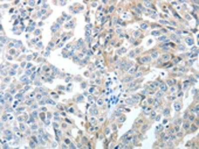 The image on the left is immunohistochemistry of paraffin-embedded Human ovarian cancer tissue using TP63 Antibody(TP63 Antibody) at dilution 1/20, on the right is treated with fusion protein. (Original magnification: ×200)Rabbit anti-Human TP63 Polyclonal Antibody