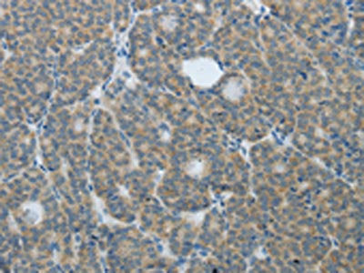 The image on the left is immunohistochemistry of paraffin-embedded Human thyroid cancer tissue using the antibody Antibody) at dilution 1/20, on the right is treated with fusion protein. (Original magnification: ×200)Rabbit anti-Human TP63 Polyclonal Antibody
