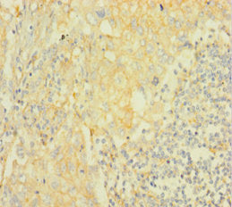 Immunohistochemistry of paraffin-embedded human lung cancer using AKT2 Antibody at dilution of 1:100Rabbit anti-Human AKT2 Polyclonal Antibody