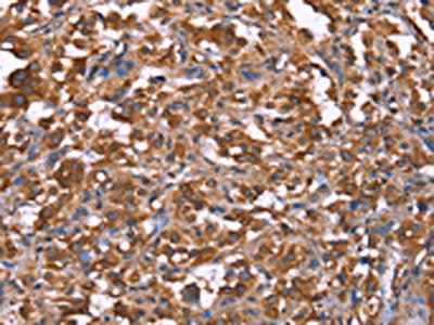 The image on the left is immunohistochemistry of paraffin-embedded Human thyroid cancer tissue using HRASLS2 Antibody(HRASLS2 Antibody) at dilution 1/40, on the right is treated with synthetic peptide. (Original magnification: ×200)Rabbit anti-Human HRASLS2 Polyclonal Antibody