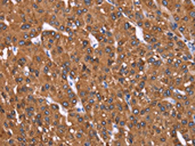 The image on the left is immunohistochemistry of paraffin-embedded Human liver cancer tissue using the antibody Antibody) at dilution 1/40, on the right is treated with synthetic peptide. (Original magnification: ×200)Rabbit anti-Human HRASLS2 Polyclonal Antibody