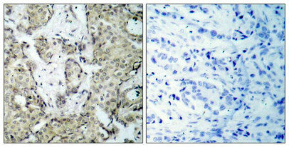 Immunohistochemical analysis of paraffin-embedded human breast carcinoma tissue using MKK3(Phospho-Ser189) Antibody(left) or the same antibody preincubated with blocking peptide(right).