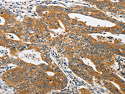 The image on the left is immunohistochemistry of paraffin-embedded Human gastric cancer tissue using PIK3R3 Antibody(PIK3R3 Antibody) at dilution 1/25, on the right is treated with synthetic peptide. (Original magnification: ×200)Rabbit anti-Human PIK3R3 Polyclonal Antibody