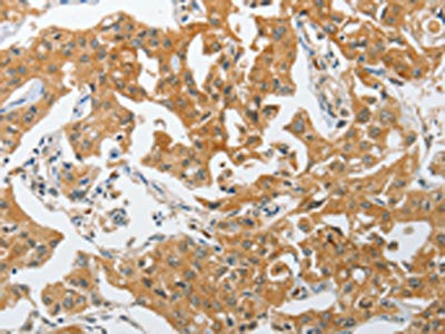 The image on the left is immunohistochemistry of paraffin-embedded Human lung cancer tissue using the antibody Antibody) at dilution 1/25, on the right is treated with synthetic peptide. (Original magnification: ×200)Rabbit anti-Human PIK3R3 Polyclonal Antibody