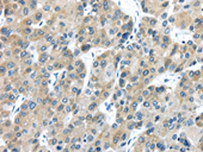 The image on the left is immunohistochemistry of paraffin-embedded Human liver cancer tissue using TXNDC5 Antibody(TXNDC5 Antibody) at dilution 1/40, on the right is treated with fusion protein. (Original magnification: ×200)Rabbit anti-Human TXNDC5 Polyclonal Antibody