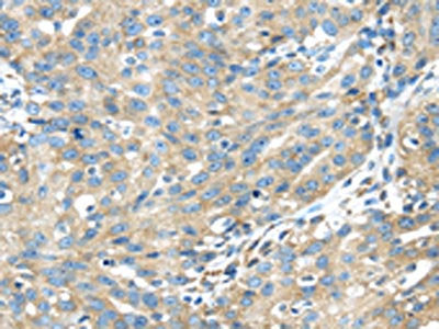 The image on the left is immunohistochemistry of paraffin-embedded Human breast cancer tissue using the antibody Antibody) at dilution 1/40, on the right is treated with fusion protein. (Original magnification: ×200)Rabbit anti-Human TXNDC5 Polyclonal Antibody