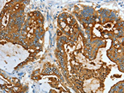 The image on the left is immunohistochemistry of paraffin-embedded Human colon cancer tissue using CEACAM5 Antibody(CEACAM5 Antibody) at dilution 1/20, on the right is treated with fusion protein. (Original magnification: ×200)Rabbit anti-Human CEACAM5 Polyclonal Antibody