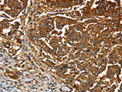 The image on the left is immunohistochemistry of paraffin-embedded Human gastic cancer tissue using the antibody Antibody) at dilution 1/20, on the right is treated with fusion protein. (Original magnification: ×200)Rabbit anti-Human CEACAM5 Polyclonal Antibody