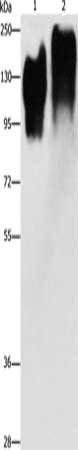 Gel: 8%SDS-PAGE, Lysate: 40 μg, Lane 1-2: Human liver cancer tissue, Human lung cancer tissue, Primary antibody: CEACAM5 Antibody(CEACAM5 Antibody) at dilution 1/350, Secondary antibody: Goat anti rabbit IgG at 1/8000 dilution, Exposure time: 30 secondsRabbit anti-Human CEACAM5 Polyclonal Antibody