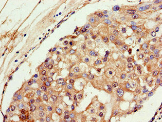 Immunohistochemistry of paraffin-embedded human breast cancer using FOXO1 Antibody at dilution of 1:100Rabbit anti-Human FOXO1 Polyclonal Antibody