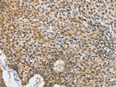 The image on the left is immunohistochemistry of paraffin-embedded Human lung cancer tissue using UBQLN1 Antibody(UBQLN1 Antibody) at dilution 1/15, on the right is treated with fusion protein. (Original magnification: ×200)Rabbit anti-Human UBQLN1 Polyclonal Antibody