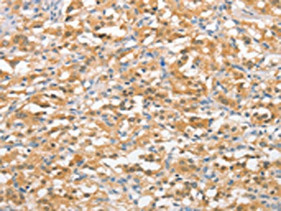 The image on the left is immunohistochemistry of paraffin-embedded Human thyroid cancer tissue using the antibody Antibody) at dilution 1/15, on the right is treated with fusion protein. (Original magnification: ×200)Rabbit anti-Human UBQLN1 Polyclonal Antibody