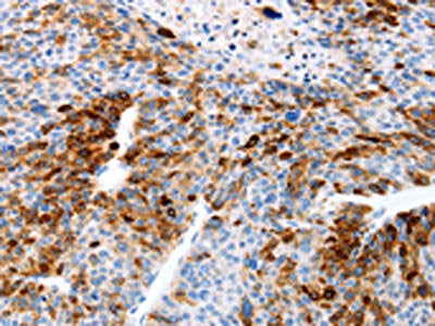 The image on the left is immunohistochemistry of paraffin-embedded Human liver cancer tissue using TFF1 Antibody(TFF1 Antibody) at dilution 1/20, on the right is treated with fusion protein. (Original magnification: ×200)Rabbit anti-Human TFF1 Polyclonal Antibody