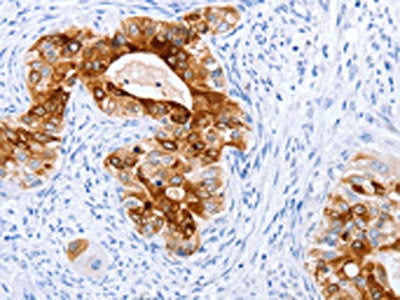 The image on the left is immunohistochemistry of paraffin-embedded Human cervical cancer tissue using the antibody Antibody) at dilution 1/20, on the right is treated with fusion protein. (Original magnification: ×200)Rabbit anti-Human TFF1 Polyclonal Antibody