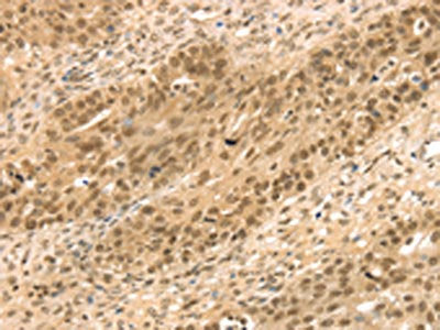 The image on the left is immunohistochemistry of paraffin-embedded Human breast cancer tissue using STAG2 Antibody(STAG2 Antibody) at dilution 1/35, on the right is treated with fusion protein. (Original magnification: ×200)Rabbit anti-Human STAG2 Polyclonal Antibody