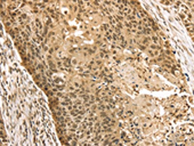 The image on the left is immunohistochemistry of paraffin-embedded Human esophagus cancer tissue using the antibody Antibody) at dilution 1/35, on the right is treated with fusion protein. (Original magnification: ×200)Rabbit anti-Human STAG2 Polyclonal Antibody