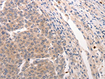 The image on the left is immunohistochemistry of paraffin-embedded Human breast cancer tissue using the antibody Antibody) at dilution 1/20, on the right is treated with synthetic peptide. (Original magnification: ×200)Rabbit anti-Human CDC37 Polyclonal Antibody