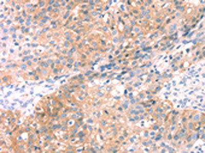 The image on the left is immunohistochemistry of paraffin-embedded Human breast cancer tissue using SNAP23 Antibody(SNAP23 Antibody) at dilution 1/25, on the right is treated with fusion protein. (Original magnification: ×200)Rabbit anti-Human SNAP23 Polyclonal Antibody