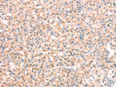The image on the left is immunohistochemistry of paraffin-embedded Human prostate cancer tissue using the antibody Antibody) at dilution 1/25, on the right is treated with fusion protein. (Original magnification: ×200)Rabbit anti-Human SNAP23 Polyclonal Antibody