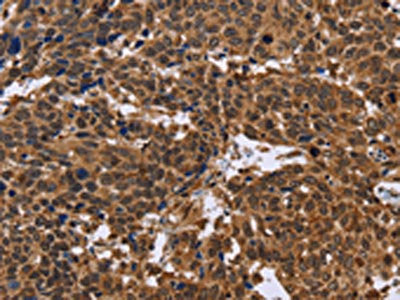 The image on the left is immunohistochemistry of paraffin-embedded Human cervical cancer tissue using the antibody Antibody) at dilution 1/30, on the right is treated with fusion protein. (Original magnification: ×200)Rabbit anti-Human EDN2 Polyclonal Antibody