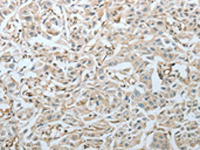 The image on the left is immunohistochemistry of paraffin-embedded Human lung cancer tissue using CRMP1 Antibody(CRMP1 Antibody) at dilution 1/20, on the right is treated with fusion protein. (Original magnification: ×200)Rabbit anti-Human CRMP1 Polyclonal Antibody