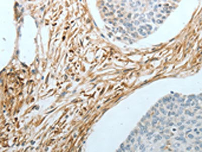 The image on the left is immunohistochemistry of paraffin-embedded Human cervical cancer tissue using the antibody Antibody) at dilution 1/20, on the right is treated with fusion protein. (Original magnification: ×200)Rabbit anti-Human CRMP1 Polyclonal Antibody