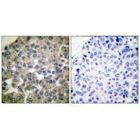Immunohistochemical analysis of paraffin-embedded human breast carcinoma tissue using PLCG1 (Ab-771) antibody.Rabbit anti-Human PLCG1 Polyclonal Antibody