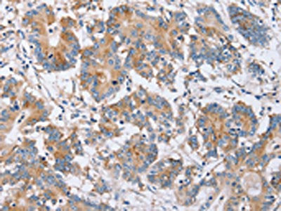 The image on the left is immunohistochemistry of paraffin-embedded Human colon cancer tissue using PPM1F Antibody(PPM1F Antibody) at dilution 1/40, on the right is treated with synthetic peptide. (Original magnification: ×200)Rabbit anti-Human PPM1F Polyclonal Antibody