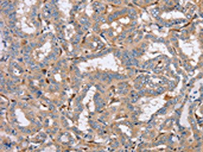 The image on the left is immunohistochemistry of paraffin-embedded Human thyroid cancer tissue using the antibody Antibody) at dilution 1/40, on the right is treated with synthetic peptide. (Original magnification: ×200)Rabbit anti-Human PPM1F Polyclonal Antibody