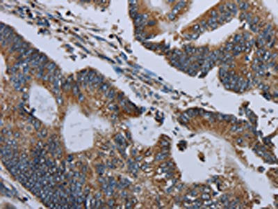 The image on the left is immunohistochemistry of paraffin-embedded Human colon cancer tissue using NDUFA13 Antibody(NDUFA13 Antibody) at dilution 1/50, on the right is treated with fusion protein. (Original magnification: ×200)Rabbit anti-Human NDUFA13 Polyclonal Antibody