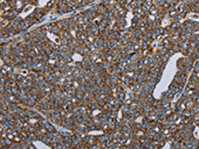 The image on the left is immunohistochemistry of paraffin-embedded Human ovarian cancer tissue using the antibody Antibody) at dilution 1/50, on the right is treated with fusion protein. (Original magnification: ×200)Rabbit anti-Human NDUFA13 Polyclonal Antibody