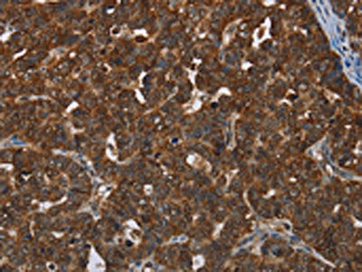 The image on the left is immunohistochemistry of paraffin-embedded Human cervical cancer tissue using CERS5 Antibody(CERS5 Antibody) at dilution 1/35, on the right is treated with synthetic peptide. (Original magnification: ×200)Rabbit anti-Human CERS5 Polyclonal Antibody
