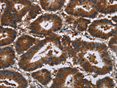 The image on the left is immunohistochemistry of paraffin-embedded Human colon cancer tissue using the antibody Antibody) at dilution 1/35, on the right is treated with synthetic peptide. (Original magnification: ×200)Rabbit anti-Human CERS5 Polyclonal Antibody